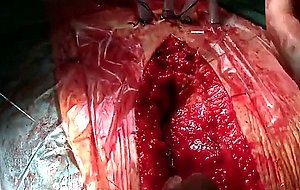 Atrial septal defect closure woman